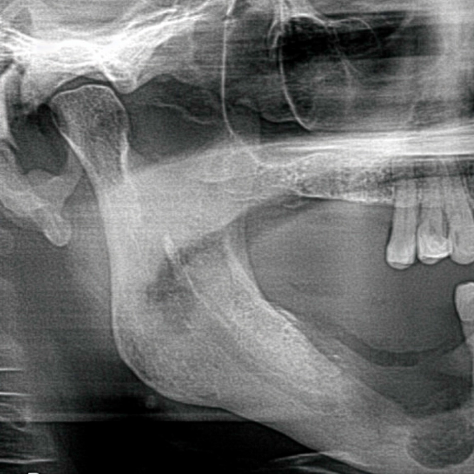 X-ray image showing jawbone necrosis